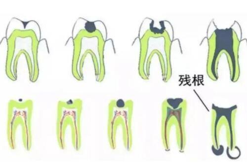 四、割了双眼皮72小时后能热敷吗?正确热敷方法学起来