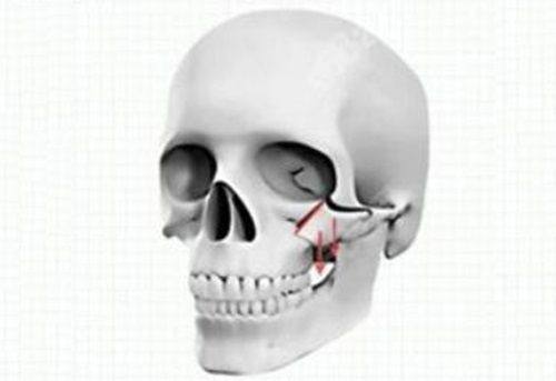 五、无痕去眼袋的真人反馈解析