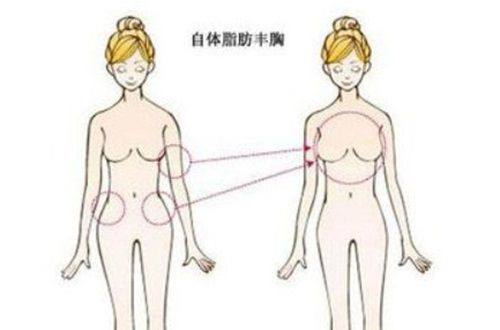 三、吸脂缩胸:从住院护理到修复正常生活的全流程