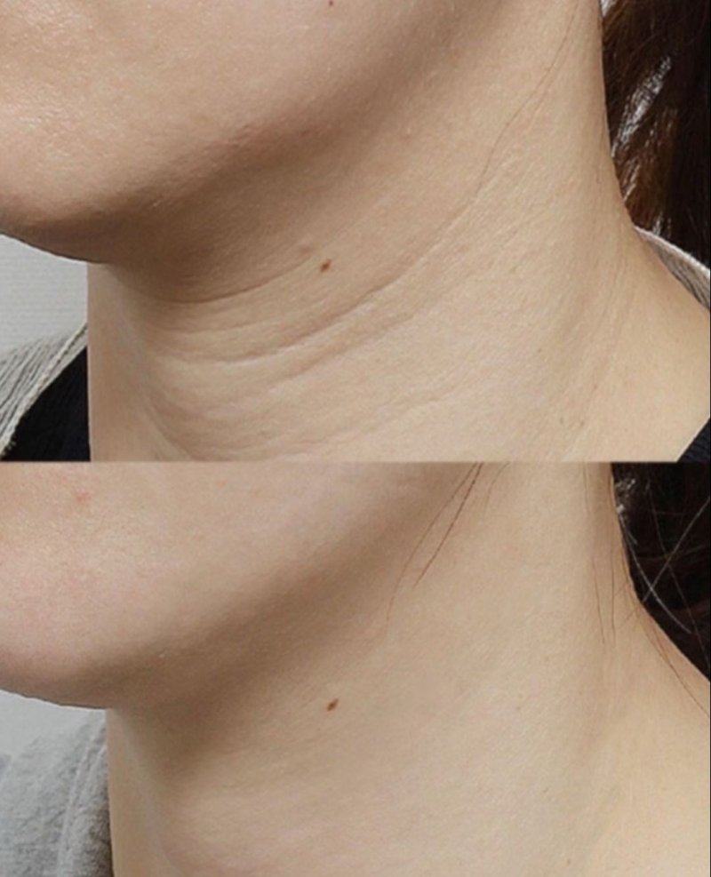 二、点阵激光治疗：脸上凹陷性疤痕的见效与淡化时长