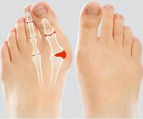 三、外切去眼袋：解决皮肤松弛伴脂肪膨出的根本方案