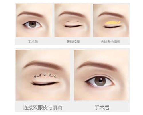 四、卧室双眼皮石膏线的实操与细节优化