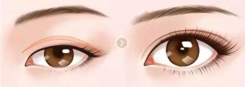 六、眼袋褶皱消除后的护理要点:巩固成效不反弹