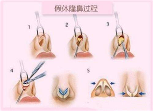 六、注射薇旖美：短期改善眼部问题的便捷选择