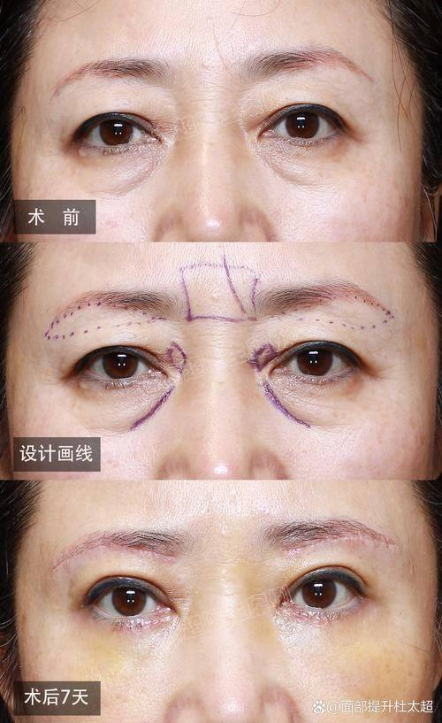 潜江蓝鸟医疗美容诊所价格表：