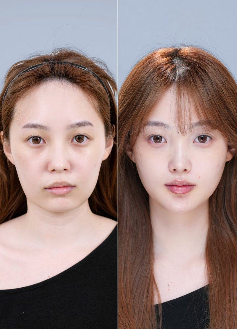 二、手术类改善方案：一次性解决眼袋与皱纹困扰