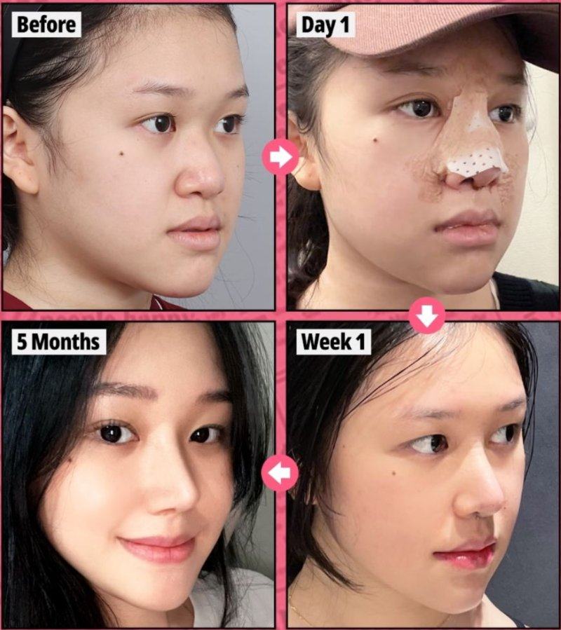 四、皮肤松弛型眼袋褶皱:提升+紧致双管齐下