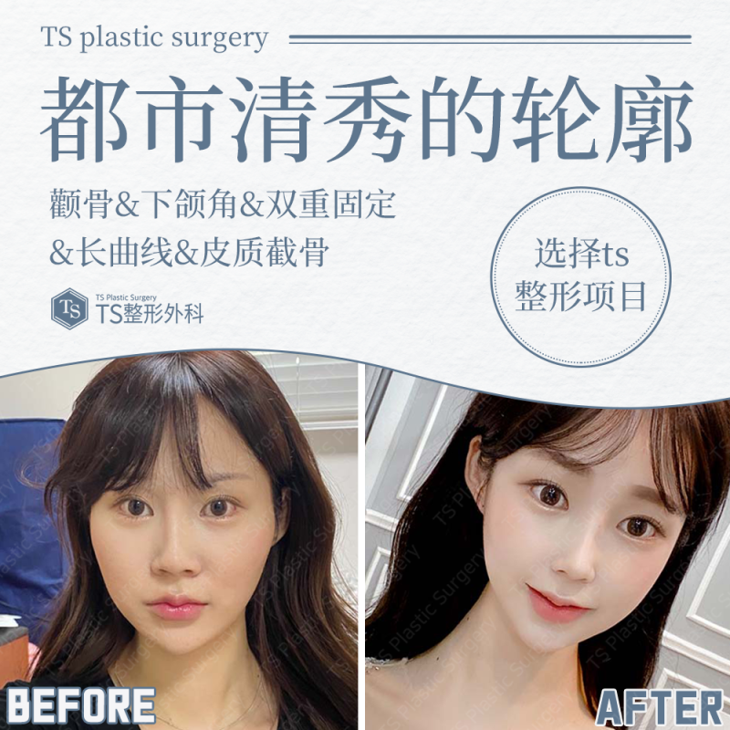 四、隆胸术前的通用年龄相关注意事项