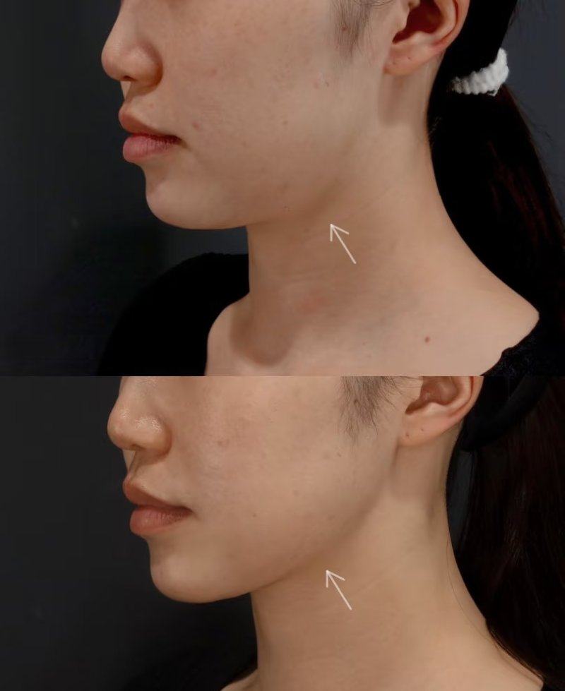 七、超声法去眼袋的关键注意事项