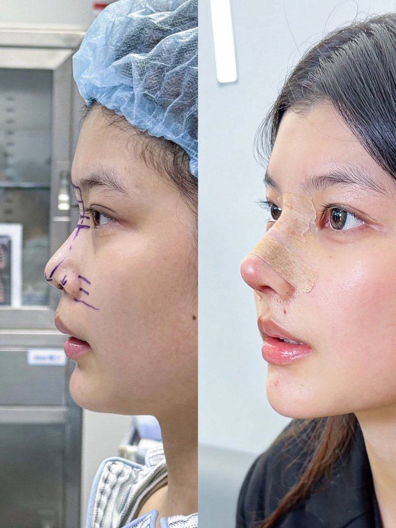 六、超声法去眼袋的核心优势