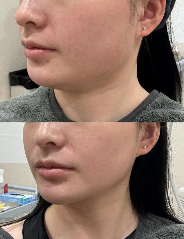 二、怎么判断宝宝是单眼皮还是双眼皮