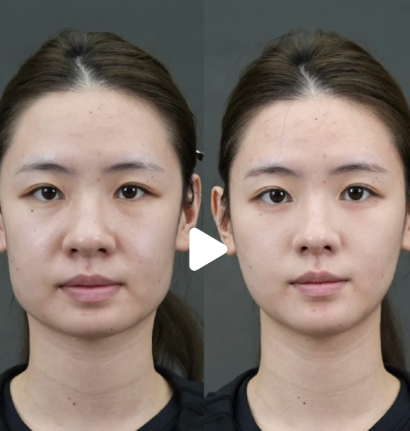 五、玻尿酸注射隆鼻的全流程时间指南