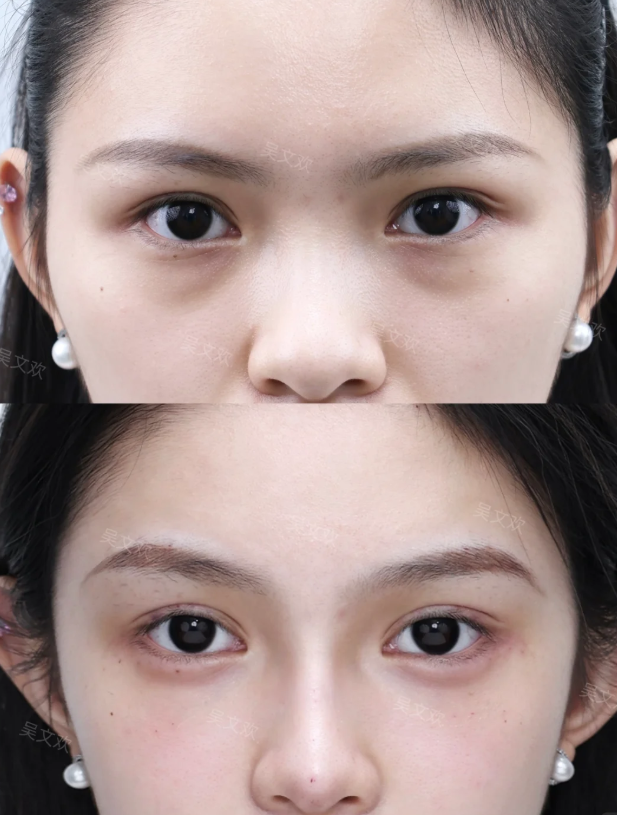 四、不同眼型的双眼皮手术适配方案