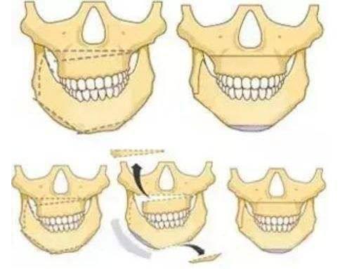 二、华美眼袋手术技术优势：为缩短修复期保驾护航