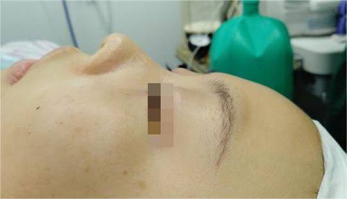 二、不同松弛程度三角眼适配的双眼皮形状