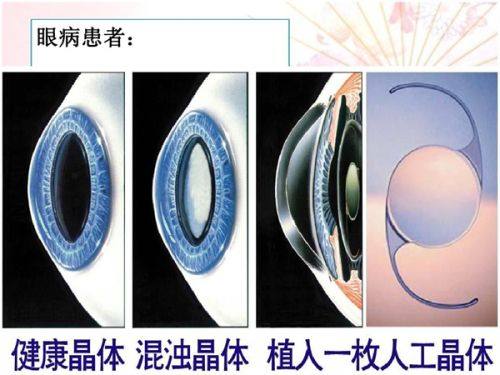 二、非手术临时方法：双眼皮贴