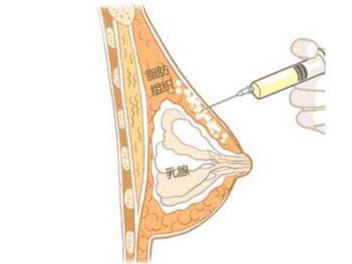 二、不同类型眼袋的针对性医美方案