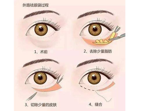 五、关于吸脂去眼袋的常见疑问解答