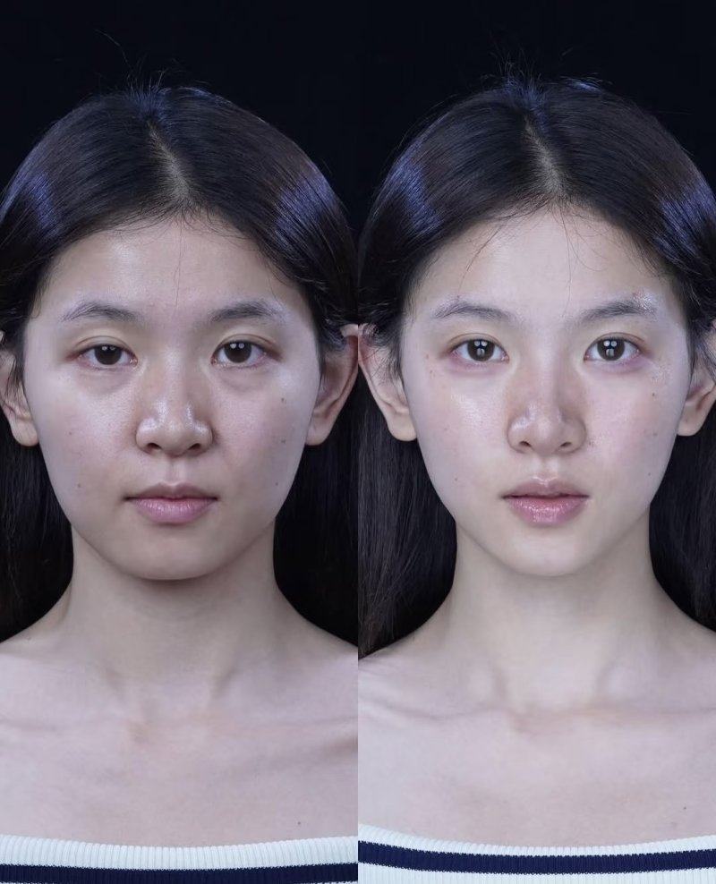 三、埋线法双眼皮（不开刀术式）