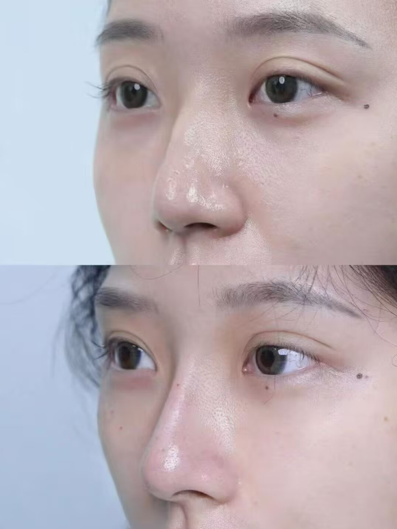 五、疤痕不规则凸起修复的常见疑问解答