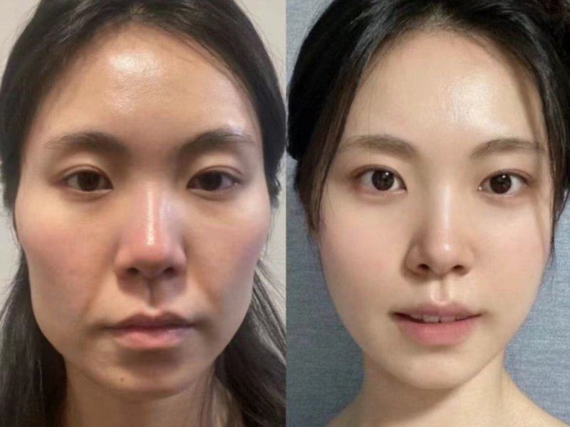 三、黑眼圈的日常护理与医美双效方案