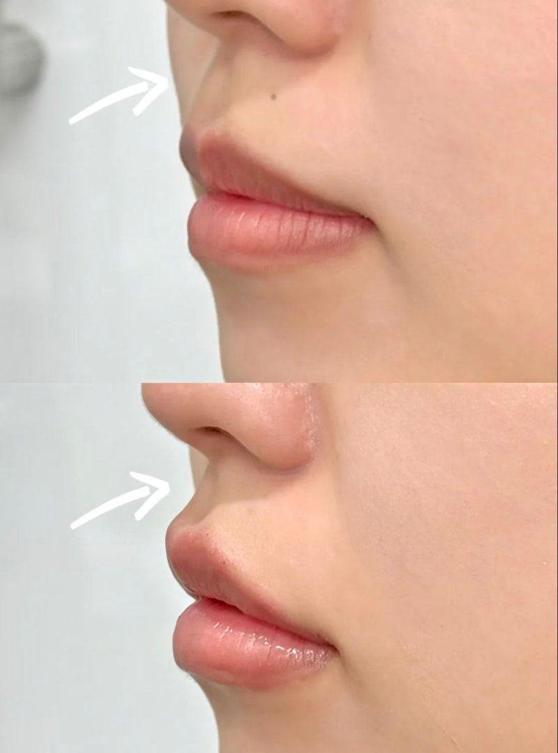 四、哪些情况必须更换假体