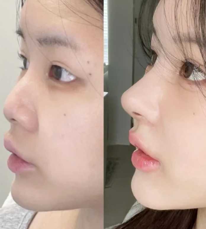 三、吸脂去眼袋的适用人群有哪些