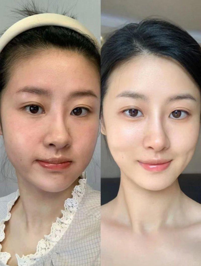 四、吸脂去眼袋手术费一般是多少