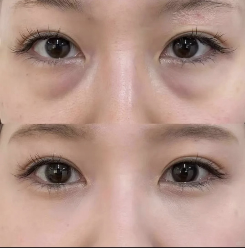 四、眶周联动新技术，一站式改善眼袋+眶周衰老