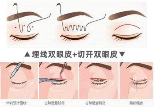 五、日常辅助:帮色素疤痕修复的小技巧