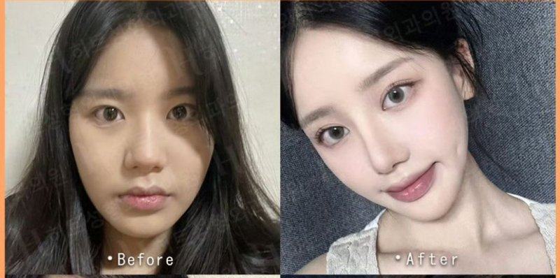 二、哪些黑眼圈能靠早睡消掉?