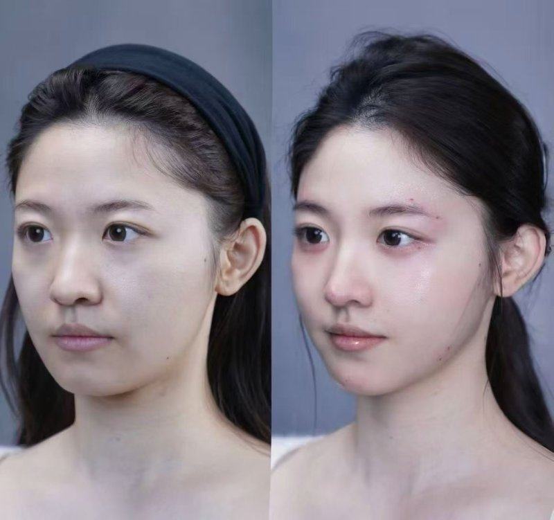 六、术后护理不当：额外放大隆鼻风险