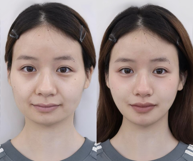 二、注射隆鼻：操作与材料不当易引发局部问题