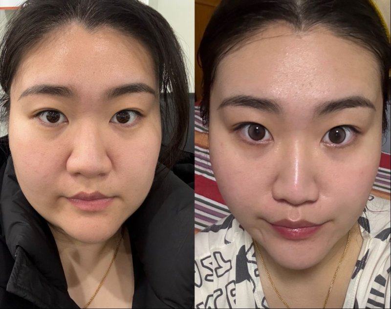 三、美人尖无痕植发核心种类详解