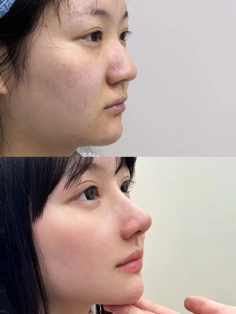 五、长期潜在风险:假体破裂与包膜挛缩