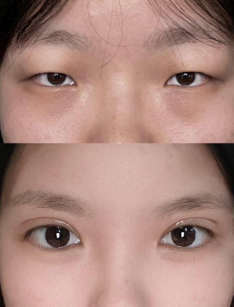 四、影响双眼皮消肿速度的关键因素