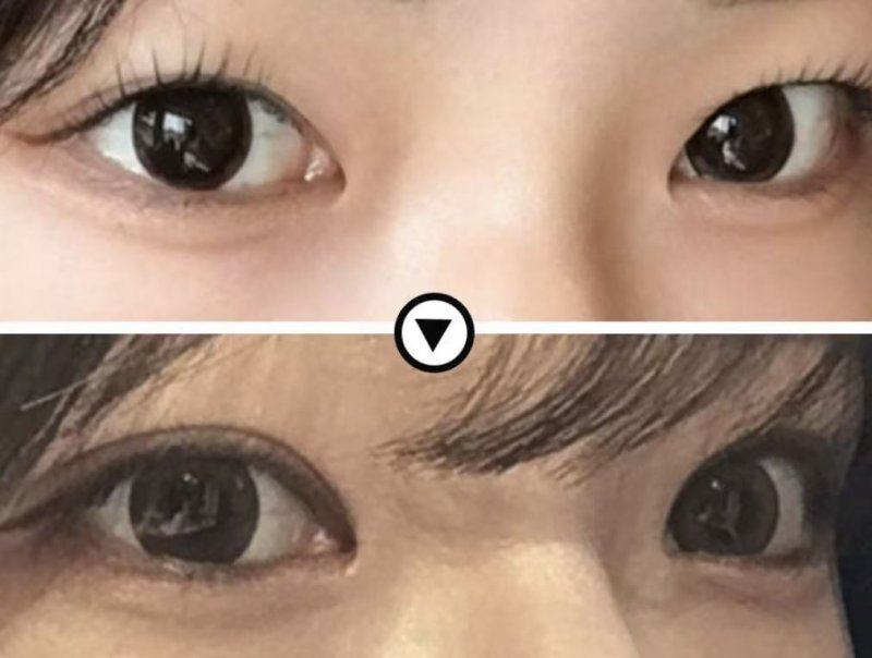 五、线提升隆鼻：风险偏高不推荐尝试