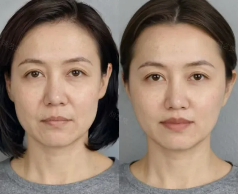 四、双眼皮手术祛疤膏要用几个月