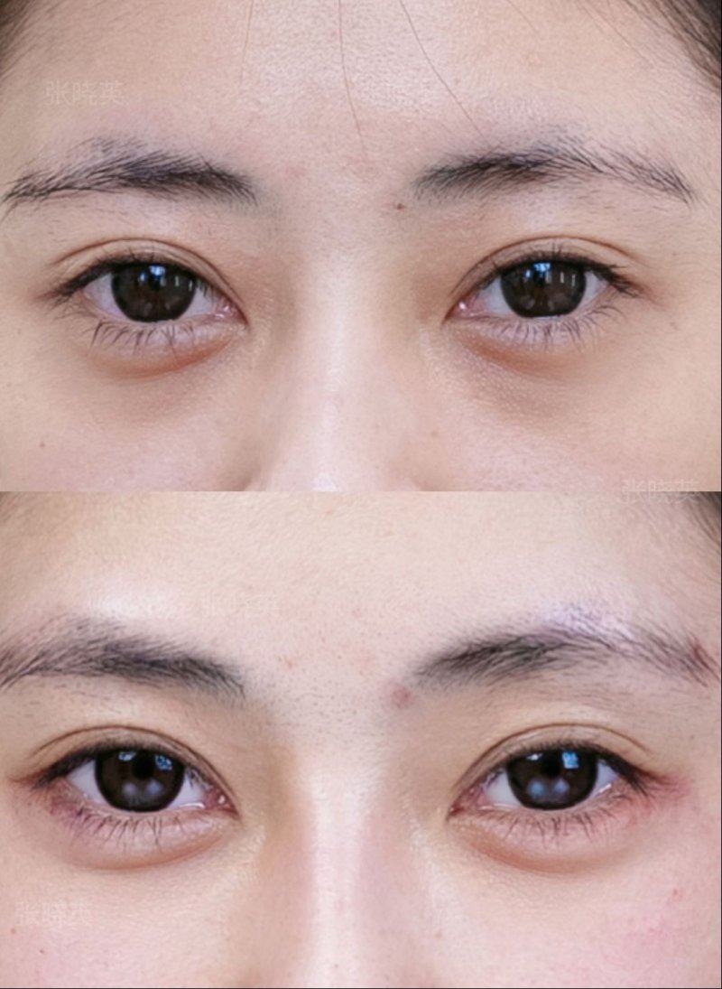 四、自体肋软骨隆鼻：传言风险多可通过专精操作规避