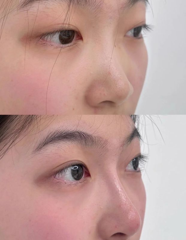 六、术后护理：细节决定埋线成效的“保质期”