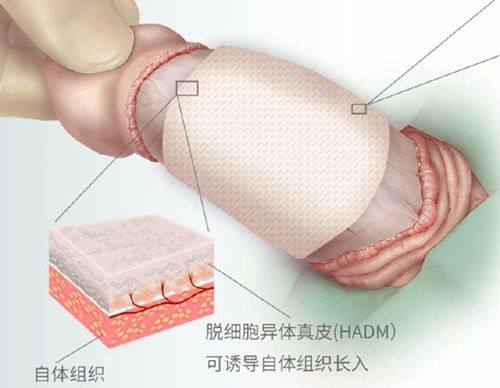 二、分深度看油烫伤疤痕的消退周期