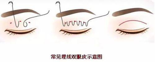 二、环钻切除与环钻减容术:原理及核心优势