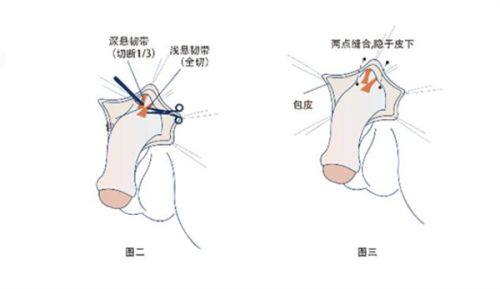 特殊情况:仅轻微浅疤可能有极淡淡化成效