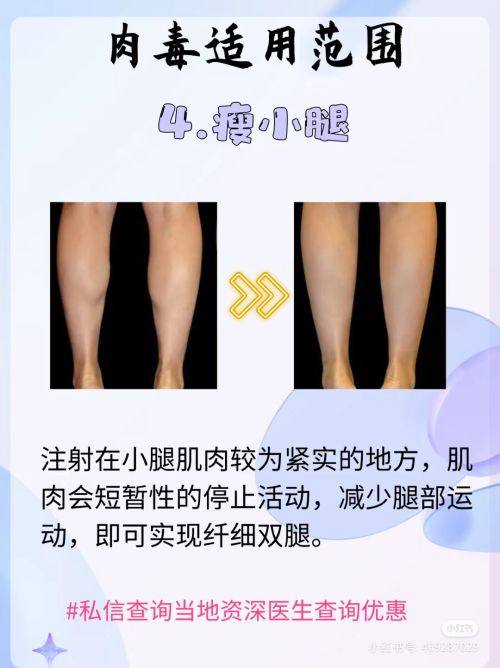 三、环钻减容术的具体治疗流程