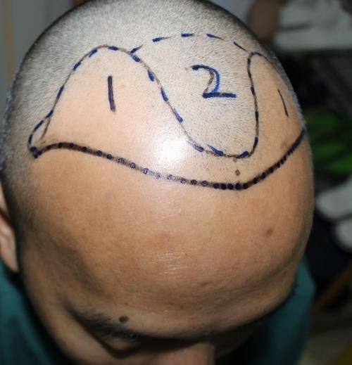 成都丝缘植发医疗美容门诊部价格表