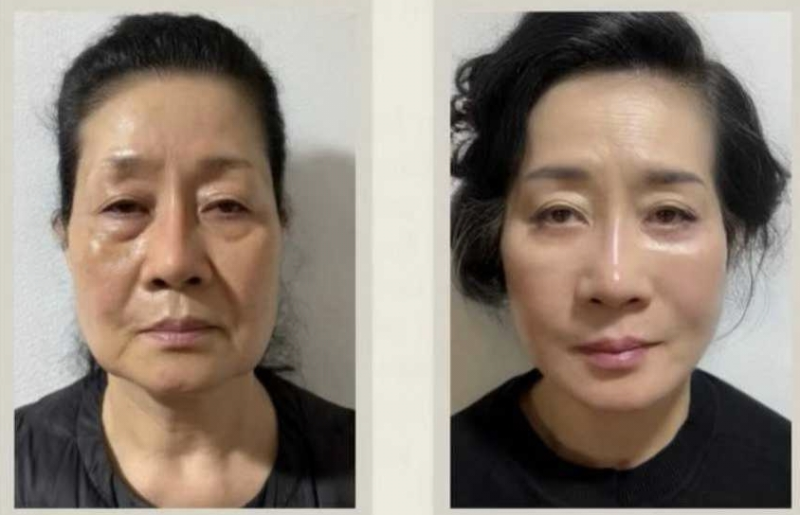 一、双眼皮一个多月可以化妆吗