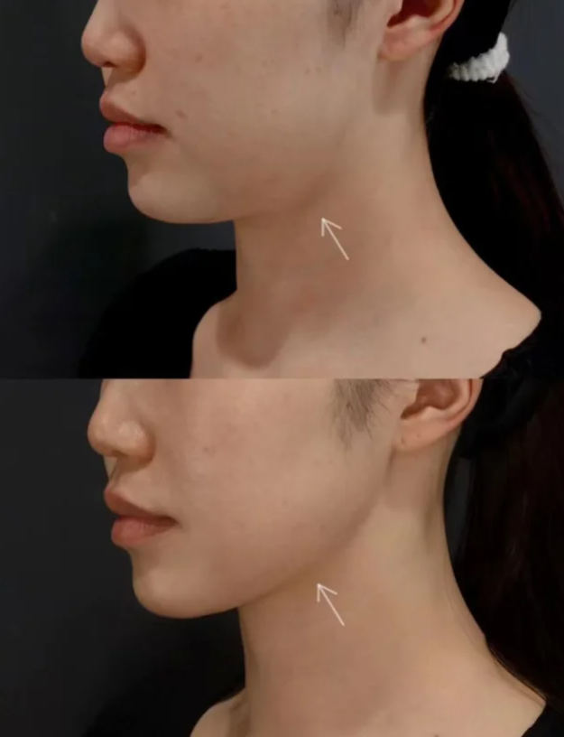 五、常见误区：术后一个多月化妆的避坑指南