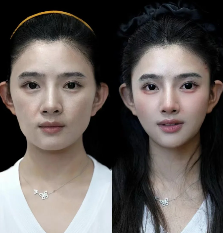 五、割双眼皮一个月的肿胀更终能消退吗