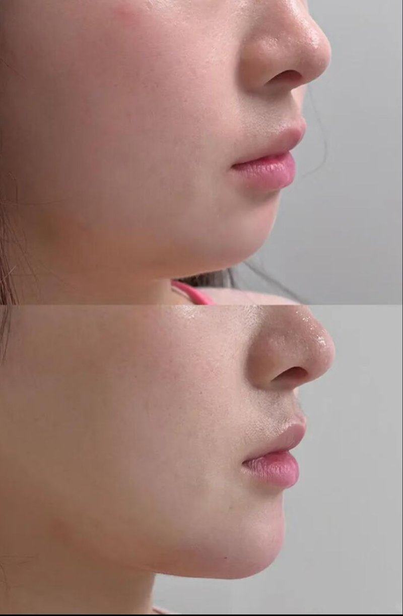 二、鸡蛋敷眼袋的成效:仅对暂时性眼袋管用