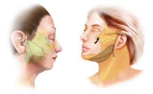 二、增生性疤痕：缝针、刀伤等凸起疤痕的去除方案